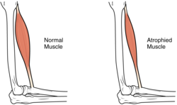 Hipertrofia e atrofia muscular
